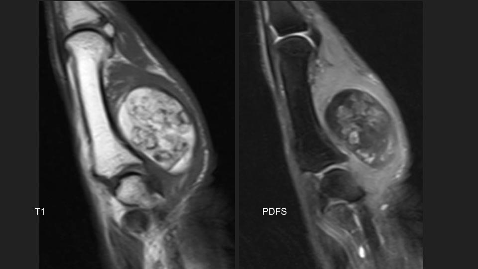 Figure 2 for case chondroma ( RID4126 )
